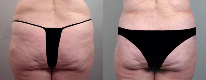 Breast Lift Case 524 Before & After View #5 | Paramus, New Jersey | Parker Center for Plastic Surgery