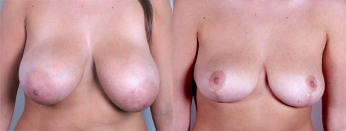 Breast Reduction Case 525 Before & After View #1 | Paramus, New Jersey | Parker Center for Plastic Surgery