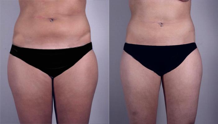 Breast Reduction Case 525 Before & After View #2 | Paramus, New Jersey | Parker Center for Plastic Surgery