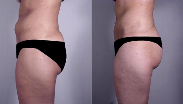 Breast Reduction Case 525 Before & After View #3 | Paramus, New Jersey | Parker Center for Plastic Surgery