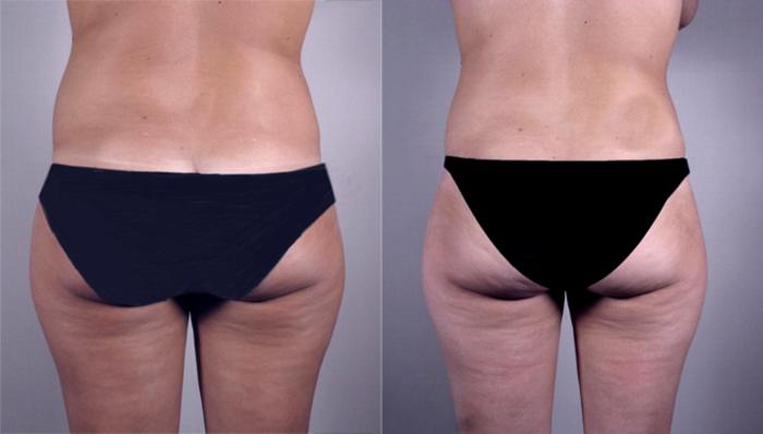 Breast Reduction Case 525 Before & After View #4 | Paramus, New Jersey | Parker Center for Plastic Surgery