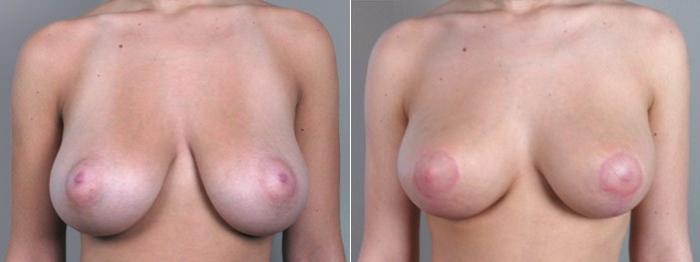 Breast Reduction Case 526 Before & After View #1 | Paramus, New Jersey | Parker Center for Plastic Surgery