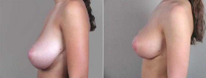 Breast Reduction Case 526 Before & After View #2 | Paramus, New Jersey | Parker Center for Plastic Surgery