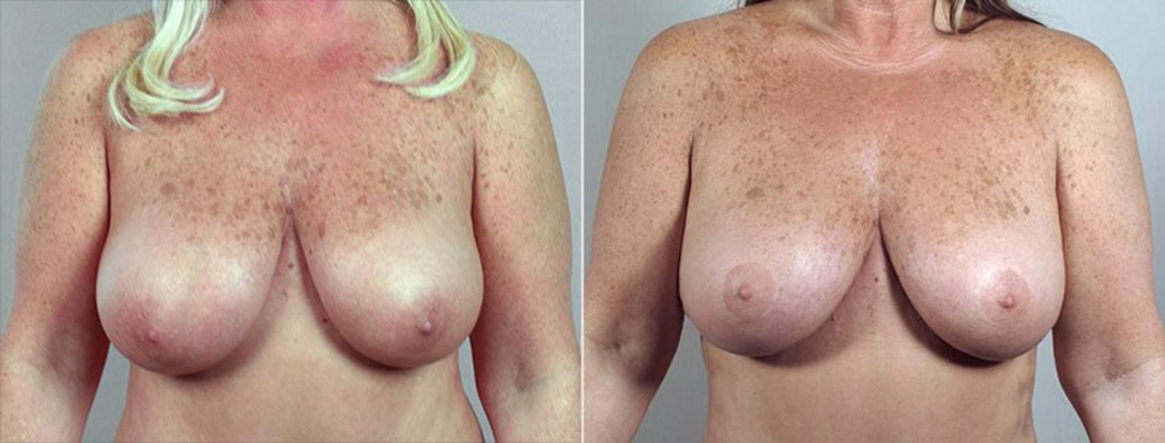 Breast Reduction Case 527 Before & After View #1 | Paramus, New Jersey | Parker Center for Plastic Surgery