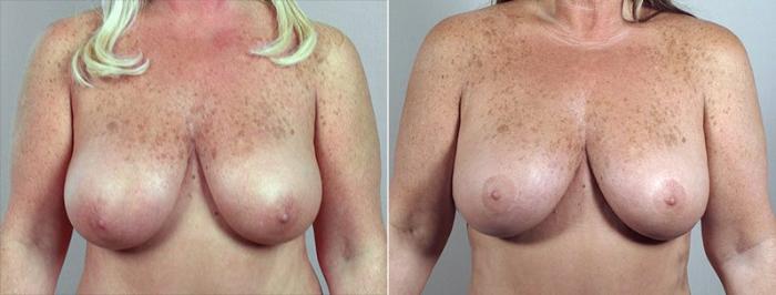Breast Reduction Case 527 Before & After View #1 | Paramus, New Jersey | Parker Center for Plastic Surgery