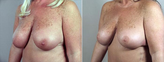 Breast Reduction Case 527 Before & After View #2 | Paramus, New Jersey | Parker Center for Plastic Surgery