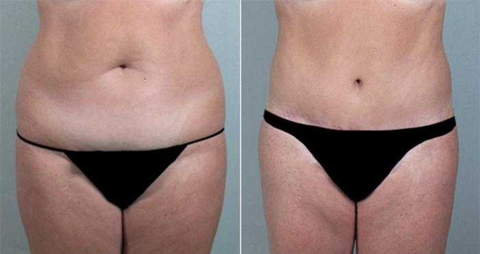 Breast Reduction Case 527 Before & After View #3 | Paramus, New Jersey | Parker Center for Plastic Surgery