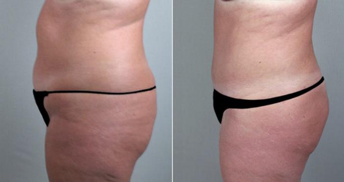 Breast Reduction Case 527 Before & After View #4 | Paramus, New Jersey | Parker Center for Plastic Surgery