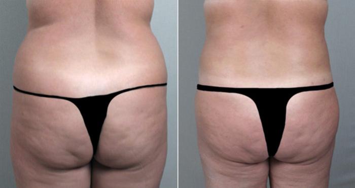 Breast Reduction Case 527 Before & After View #5 | Paramus, New Jersey | Parker Center for Plastic Surgery