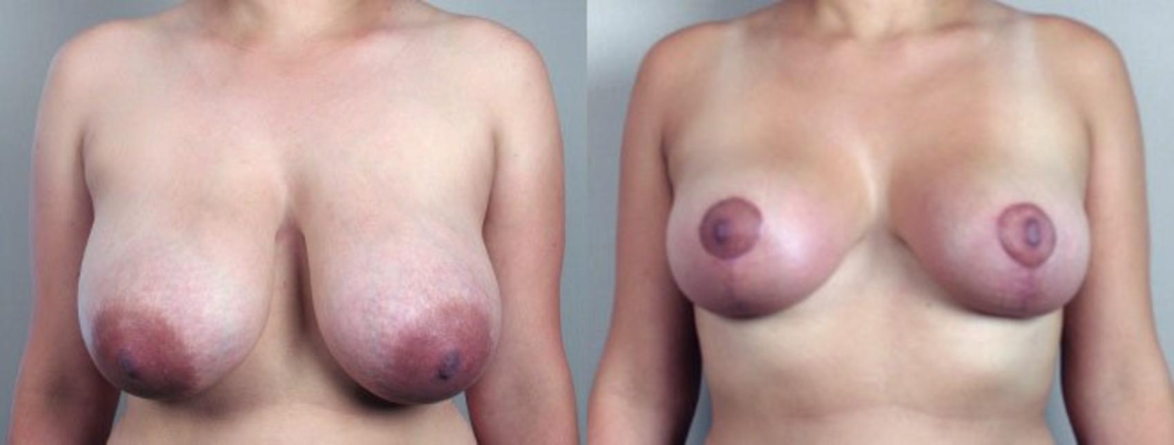 Breast Reduction Case 528 Before & After View #1 | Paramus, New Jersey | Parker Center for Plastic Surgery
