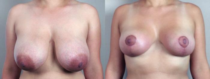 Breast Reduction Case 528 Before & After View #1 | Paramus, New Jersey | Parker Center for Plastic Surgery