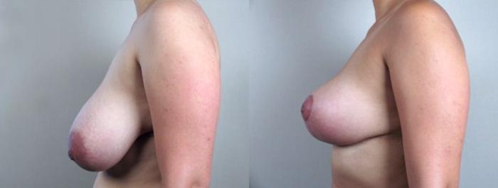 Breast Reduction Case 528 Before & After View #2 | Paramus, New Jersey | Parker Center for Plastic Surgery