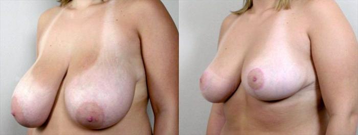 Breast Reduction Case 530 Before & After View #2 | Paramus, New Jersey | Parker Center for Plastic Surgery
