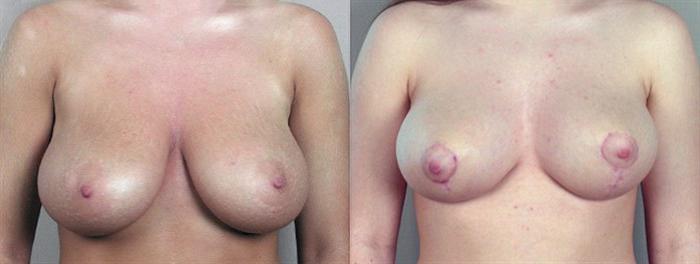Breast Reduction Case 531 Before & After View #1 | Paramus, New Jersey | Parker Center for Plastic Surgery