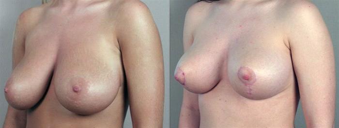 Breast Reduction Case 531 Before & After View #2 | Paramus, New Jersey | Parker Center for Plastic Surgery