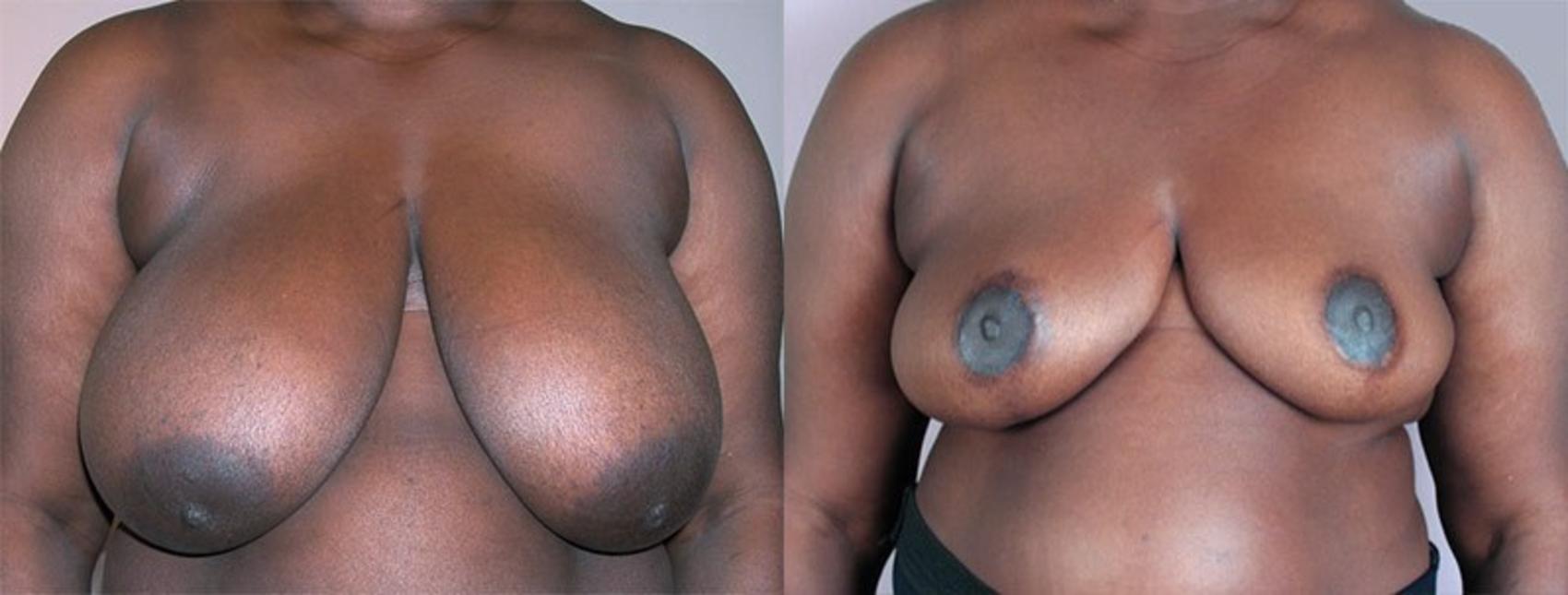 Breast Reduction Case 532 Before & After View #1 | Paramus, New Jersey | Parker Center for Plastic Surgery