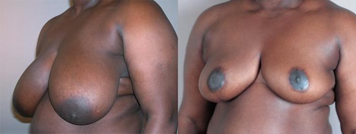 Breast Reduction Case 532 Before & After View #2 | Paramus, New Jersey | Parker Center for Plastic Surgery