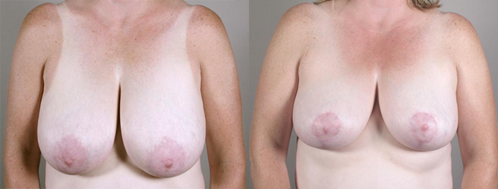 Breast Reduction Case 533 Before & After View #1 | Paramus, New Jersey | Parker Center for Plastic Surgery