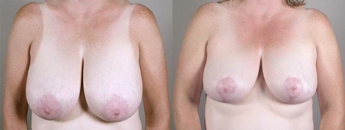 Breast Reduction Case 533 Before & After View #1 | Paramus, New Jersey | Parker Center for Plastic Surgery