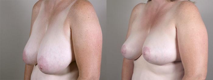 Breast Reduction Case 533 Before & After View #2 | Paramus, New Jersey | Parker Center for Plastic Surgery