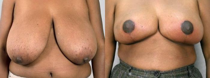 Breast Reduction Case 534 Before & After View #1 | Paramus, New Jersey | Parker Center for Plastic Surgery