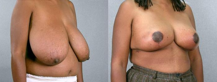 Breast Reduction Case 534 Before & After View #2 | Paramus, New Jersey | Parker Center for Plastic Surgery