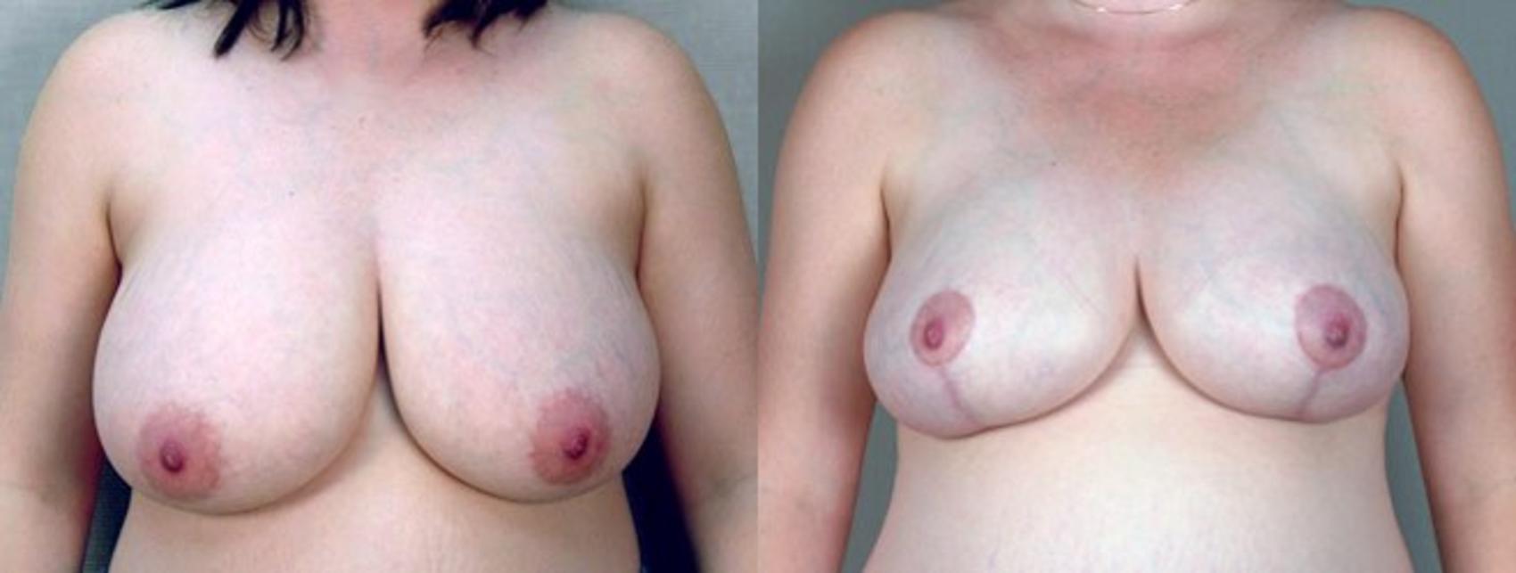 Breast Reduction Case 535 Before & After View #1 | Paramus, New Jersey | Parker Center for Plastic Surgery