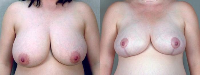 Breast Reduction Case 535 Before & After View #1 | Paramus, New Jersey | Parker Center for Plastic Surgery