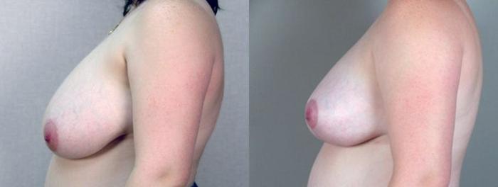 Breast Reduction Case 535 Before & After View #2 | Paramus, New Jersey | Parker Center for Plastic Surgery