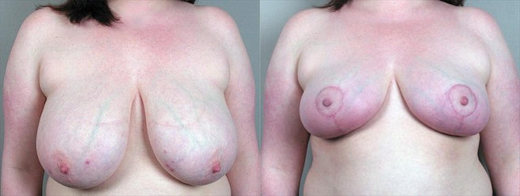 Breast Reduction Case 536 Before & After View #1 | Paramus, New Jersey | Parker Center for Plastic Surgery