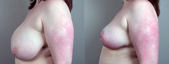 Breast Reduction Case 536 Before & After View #2 | Paramus, New Jersey | Parker Center for Plastic Surgery