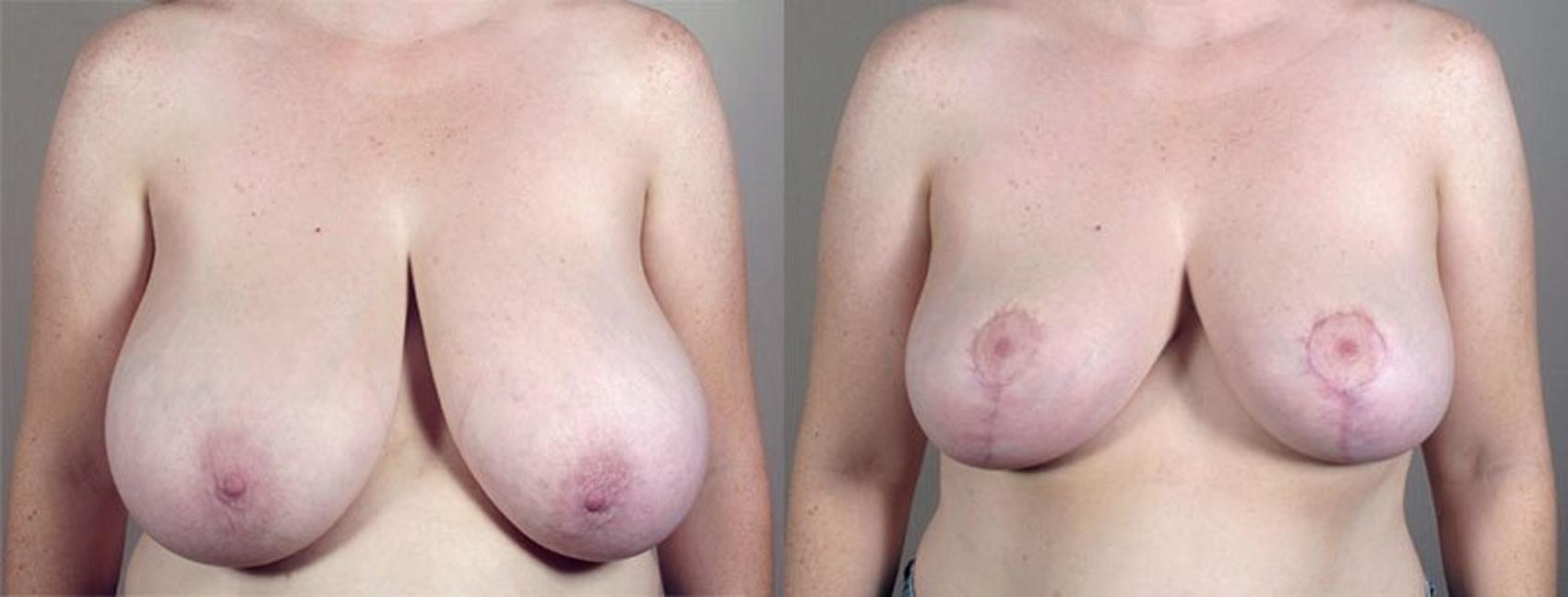 Breast Reduction Case 537 Before & After View #1 | Paramus, New Jersey | Parker Center for Plastic Surgery