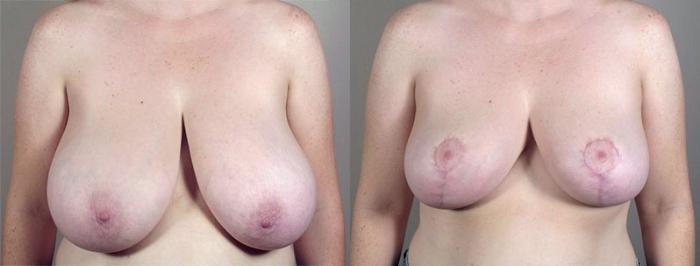 Breast Reduction Case 537 Before & After View #1 | Paramus, New Jersey | Parker Center for Plastic Surgery