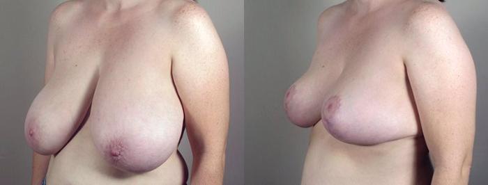 Breast Reduction Case 537 Before & After View #2 | Paramus, New Jersey | Parker Center for Plastic Surgery