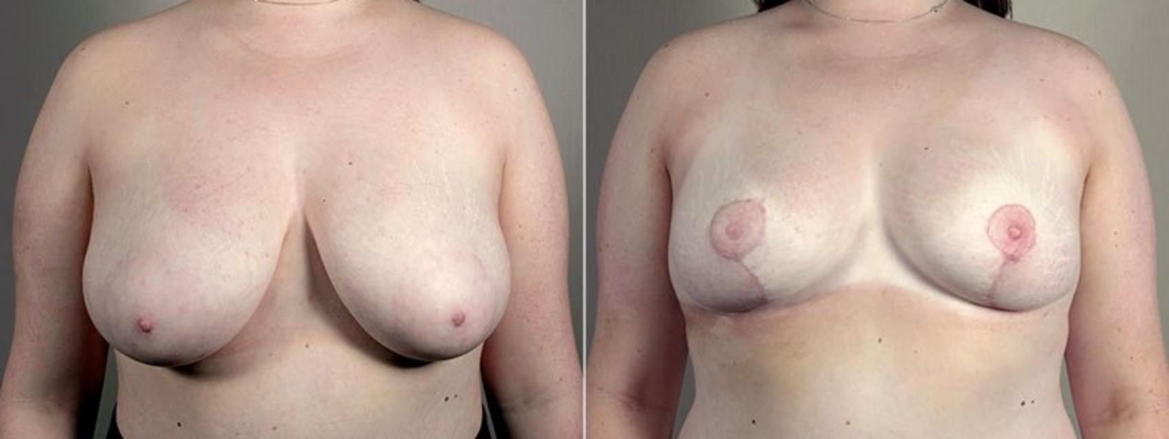 Breast Reduction Case 539 Before & After View #1 | Paramus, New Jersey | Parker Center for Plastic Surgery