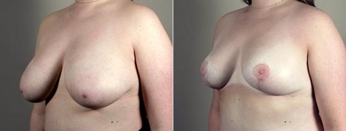 Breast Reduction Case 539 Before & After View #2 | Paramus, New Jersey | Parker Center for Plastic Surgery