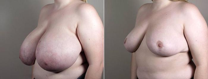 Breast Reduction Case 540 Before & After View #1 | Paramus, New Jersey | Parker Center for Plastic Surgery