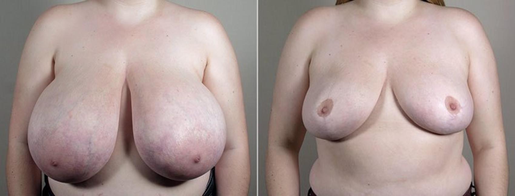 Breast Reduction Case 540 Before & After View #2 | Paramus, New Jersey | Parker Center for Plastic Surgery