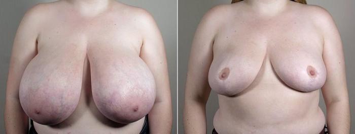 Breast Reduction Case 540 Before & After View #2 | Paramus, New Jersey | Parker Center for Plastic Surgery