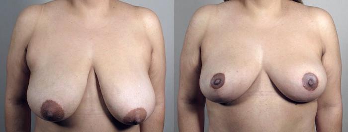 Breast Reduction Case 541 Before & After View #1 | Paramus, New Jersey | Parker Center for Plastic Surgery