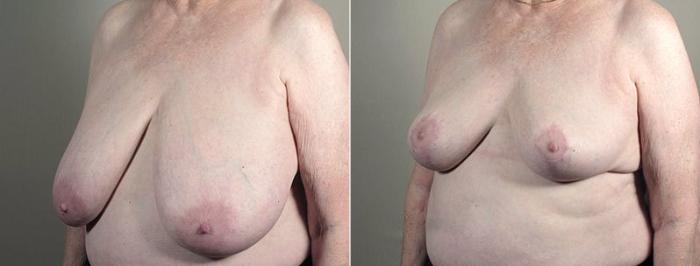Breast Reduction Case 542 Before & After View #2 | Paramus, New Jersey | Parker Center for Plastic Surgery