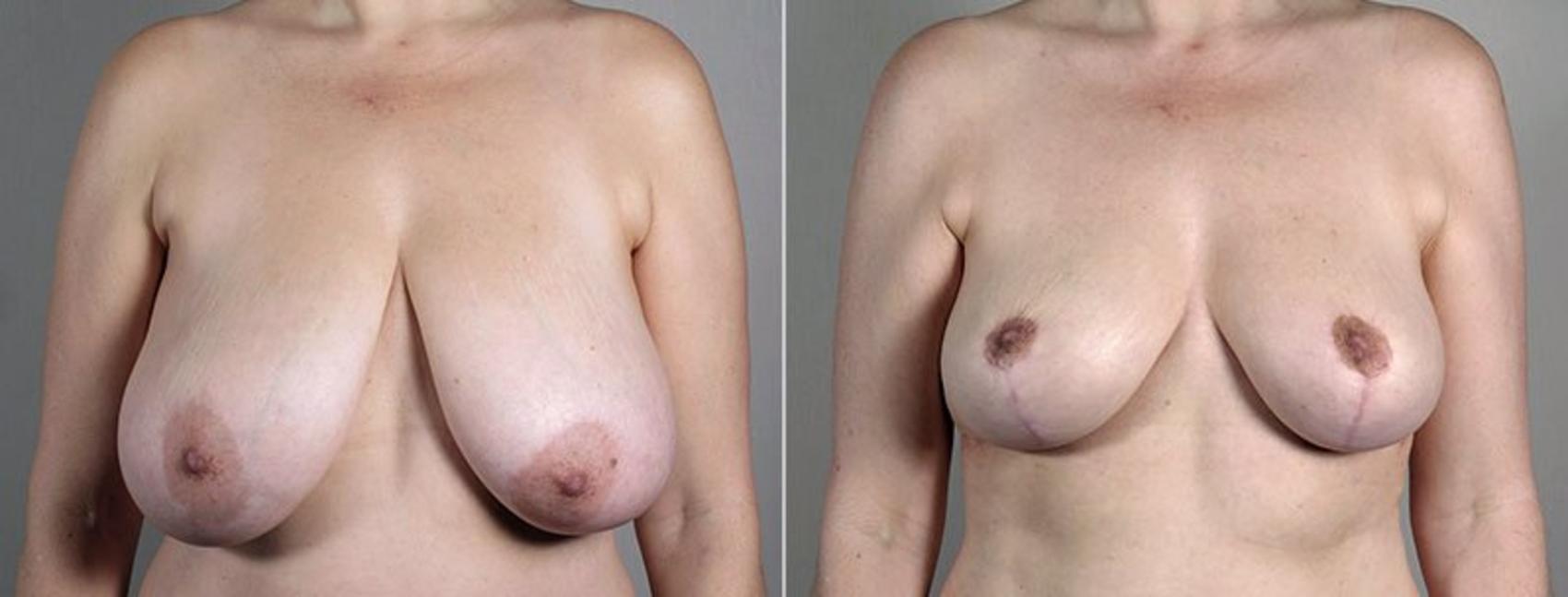 Breast Reduction Case 543 Before & After View #1 | Paramus, New Jersey | Parker Center for Plastic Surgery