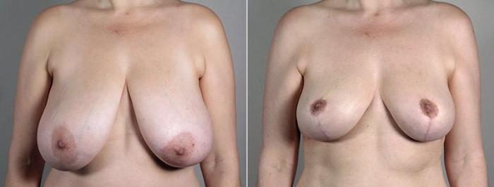 Breast Reduction Case 543 Before & After View #1 | Paramus, New Jersey | Parker Center for Plastic Surgery