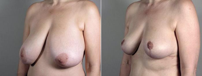 Breast Reduction Case 543 Before & After View #2 | Paramus, New Jersey | Parker Center for Plastic Surgery