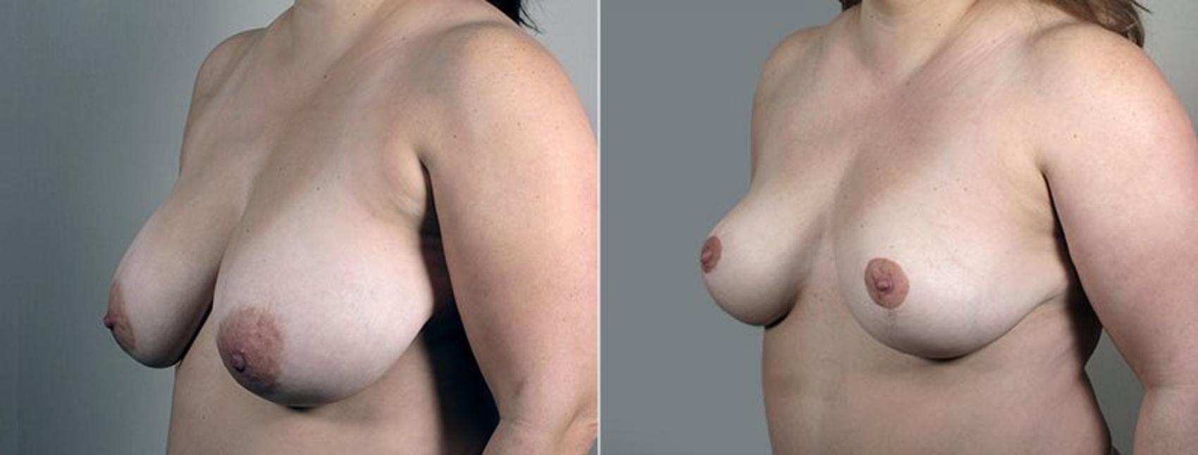 Breast Reduction Case 544 Before & After View #2 | Paramus, New Jersey | Parker Center for Plastic Surgery