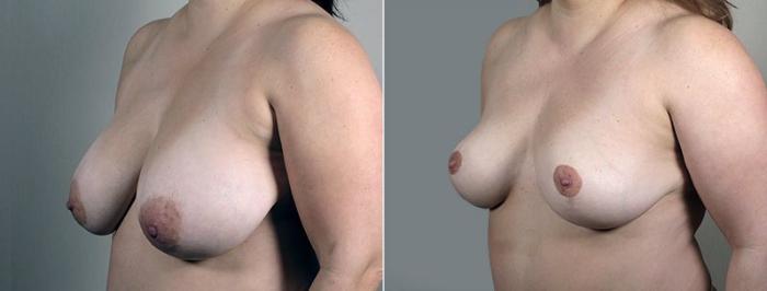Breast Reduction Case 544 Before & After View #2 | Paramus, New Jersey | Parker Center for Plastic Surgery