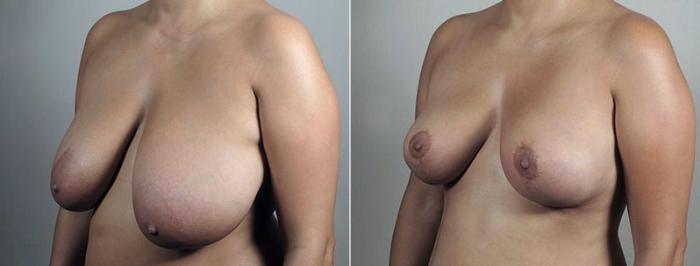 Breast Reduction Case 545 Before & After View #1 | Paramus, New Jersey | Parker Center for Plastic Surgery