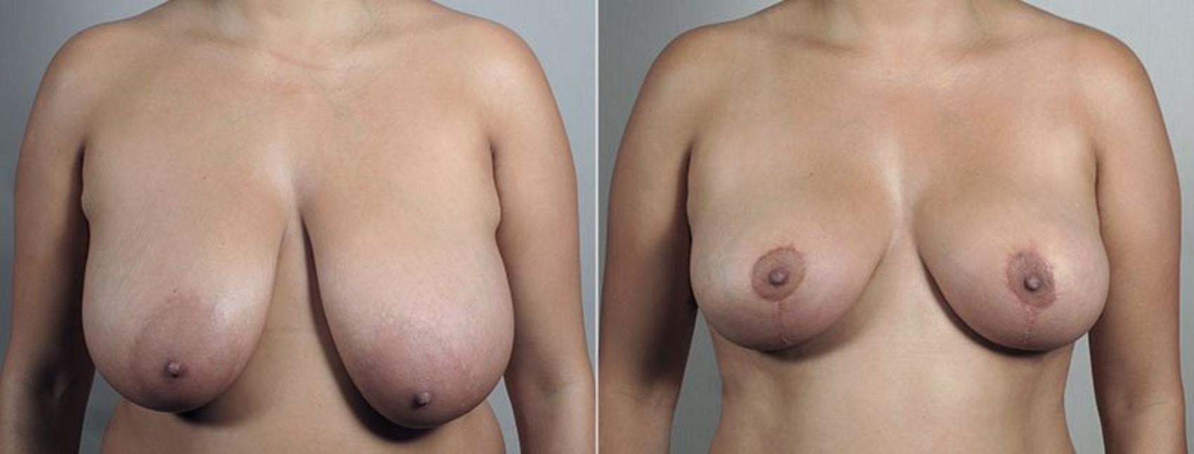 Breast Reduction Case 545 Before & After View #2 | Paramus, New Jersey | Parker Center for Plastic Surgery