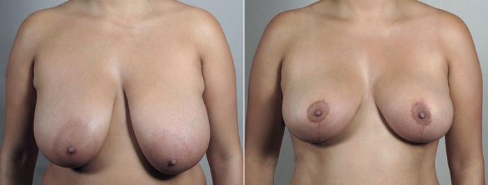 Breast Reduction Case 545 Before & After View #2 | Paramus, New Jersey | Parker Center for Plastic Surgery