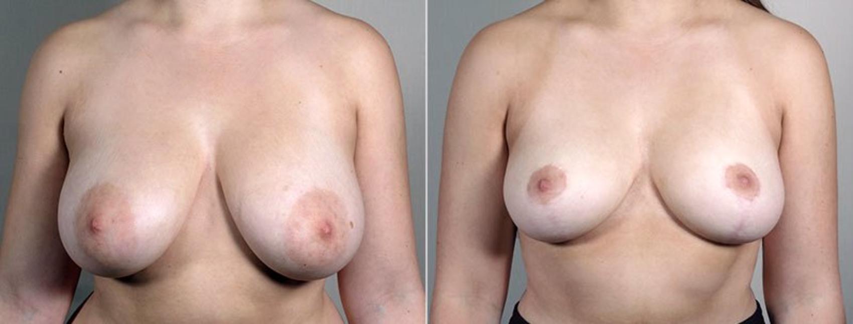 Breast Reduction Case 546 Before & After View #1 | Paramus, New Jersey | Parker Center for Plastic Surgery